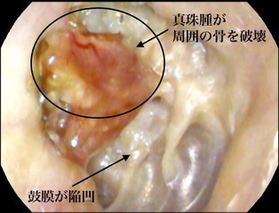 真珠腫性中耳炎・外耳道真珠